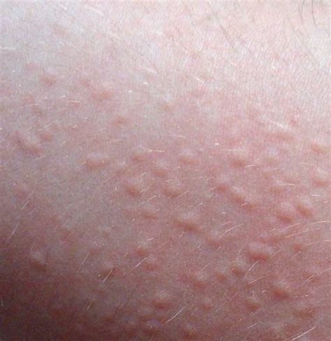 Skin Allergy Rash Cream Update Berita Olahraga Dalam Luar