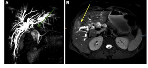 Figure 2 From Hepatoduodenal Lymph Node Metastasis Mimicking Klatskin