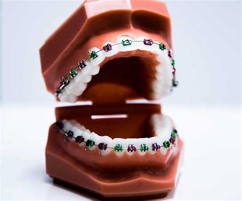 Braces Invisalign And Confident Smiles At Pinecrest Orthodontics