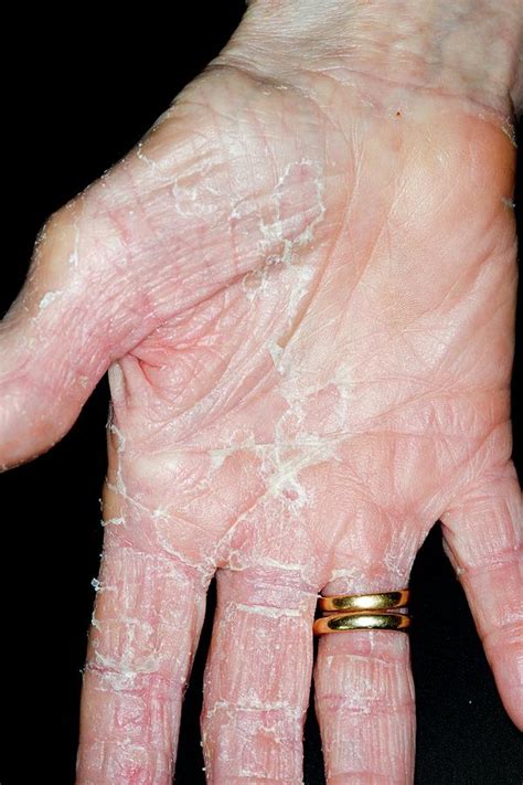 Exfoliative Dermatitis Of The Hand Photograph By Dr P Marazziscience