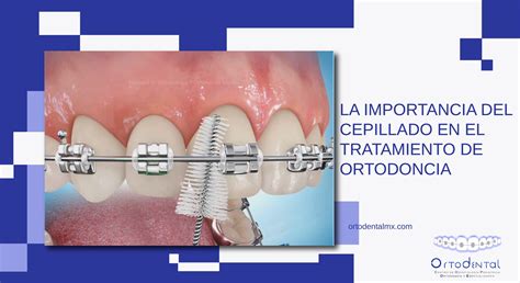 La Importancia Del Cepillado En El Tratamiento De Ortodoncia Ortodental