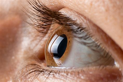 Eye Care Series Symptoms Of Keratoconus Lasik Denver Cataract Surgery
