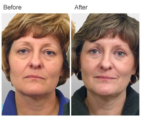 Eyelid Surgery Before And After Photos Dr Zubowicz Atlanta Ga