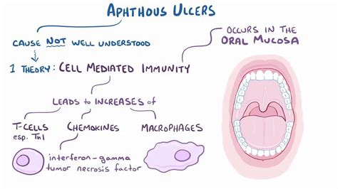 Aphthous Stomatitis Treatment