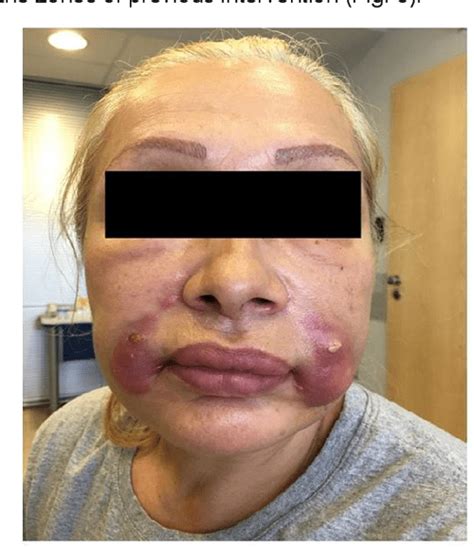 Figure 2 From Foreign Body Granuloma After Nasolabial Folds Injected