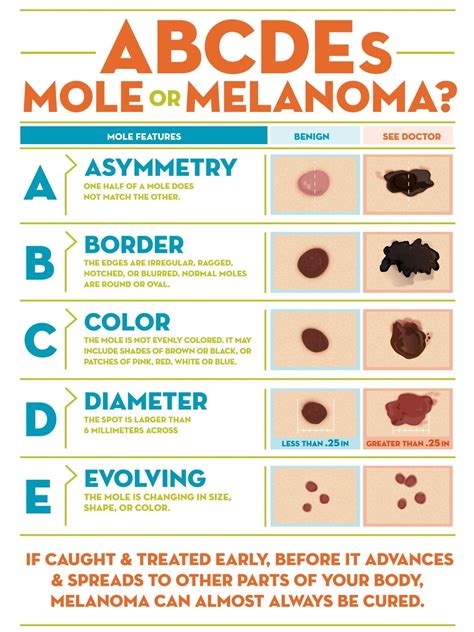 What Is Melanoma Learn The Abcde Of Moles