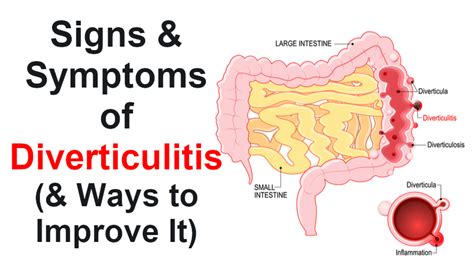 Signs And Symptoms Of Diverticulitis And Ways To Improve It Womenworking