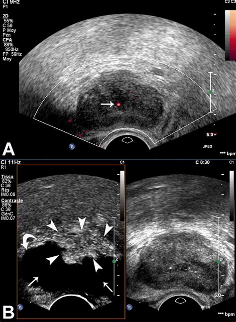 Contrast Enhanced Ultrasound And Prostate Cancer A Multicentre