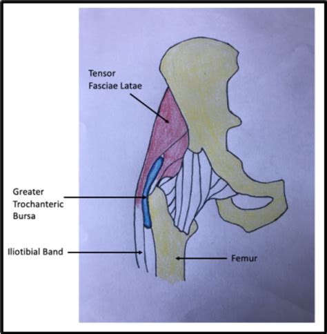 Trochanteric Bursitis Hipeducation