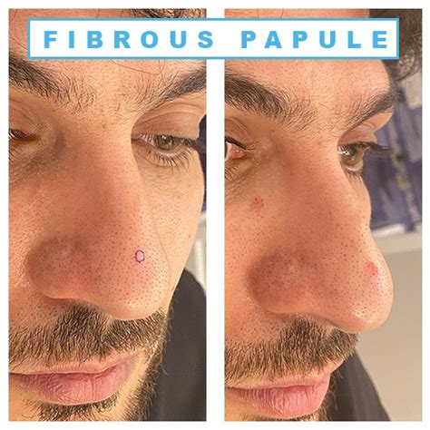 Remove Fibrous Papule Of The Nose At Home Daringcardsmakers