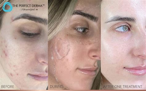 The Perfect Derma Peel Rx After Care Hayes Valley Medical Esthetics
