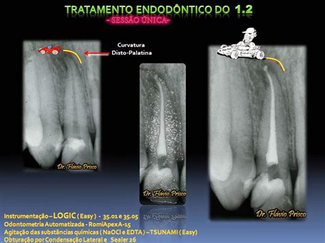 Descobrindo e explorando a Endodontia Tratamento Endodôntico do
