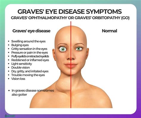 Graves Eye Disease Graves Ophthalmopathy Or Graves’ Orbitopathy Go Symptoms Causes