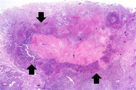 Lung Abscess Pathophysiology Wikidoc