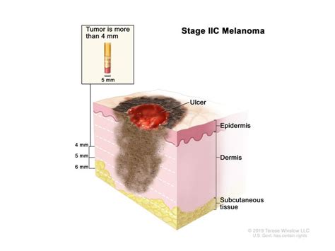 Stage 3 Melanoma Treatment