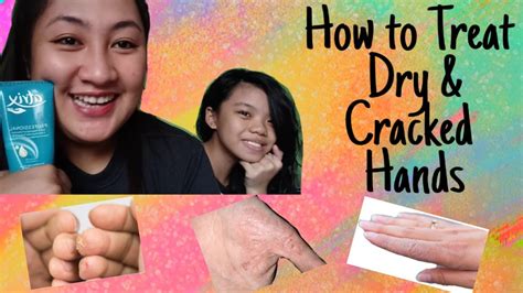 Vlog9 How To Treat Dry And Cracked Hands Youtube