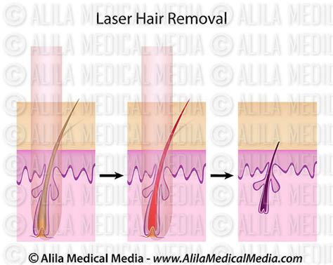 Alila Medical Media Laser Hair Removal Procedure