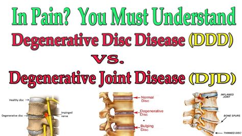 In Pain You Must Understand Degenerative Joint Disease Vs Degenerative