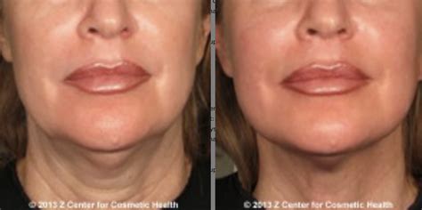 Top Jawline Treatments Ultherapy Thermitight Sculptra Kybella Z