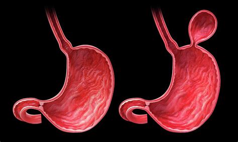 Human Stomach With Hernia Photograph By Pixologicstudio Pixels
