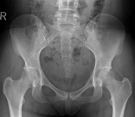 Normal Pelvis X Ray