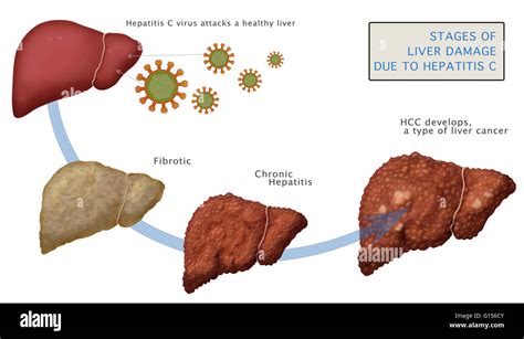 Diagram Showing Stages Of Liver Damage Due To Cirrhosis Caused By Stock