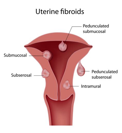 Uterine Fibroids Tenn Reproductive Med Chattanooga