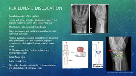 Perilunate Dislocation On Lateral Wrist Xr The Capitate