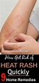 How to Get Rid of Heat Rash Quickly. 9 Natural Remedies for Heat Rash ...