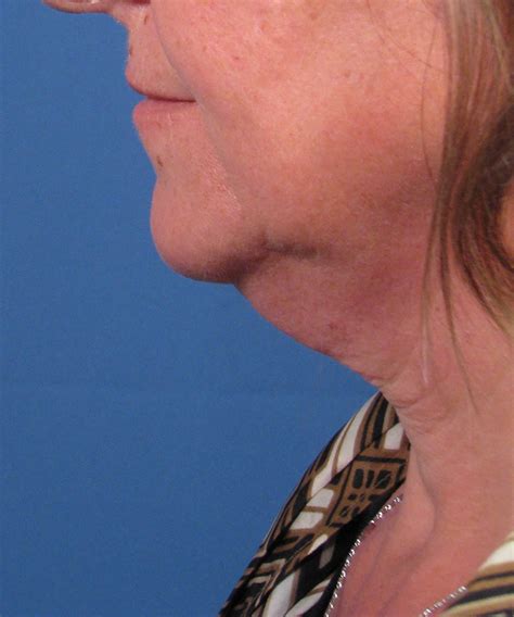 Neck Lift Case Study In San Diego With Liposuction And Platysmaplasty