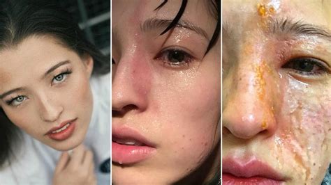 Womans Face Severely Burnt By Essential Oil Diffuser Nt News