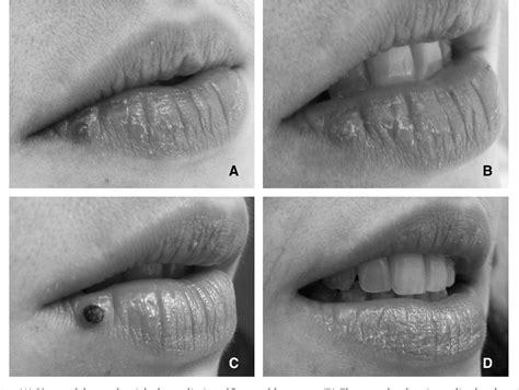 Venous Lake Of The Lips Treated Using Photocoagulation With High