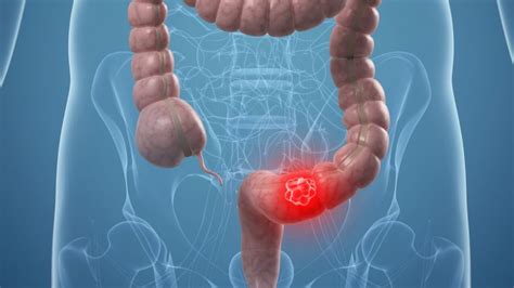 Colorectal cancer, also called colon cancer, is the second leading cause of cancer deaths in the u.s. Raising awareness about colon cancer - Jamaica Cancer Society