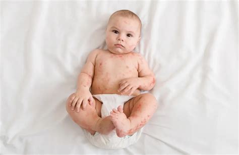 Roseola Signs And Symptoms How To Tell If Your Child Has Roseola
