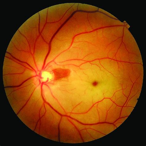 Crao Left Eye Showing Retinal Whitening With A Cherry Red Spot At The