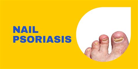 Nail Psoriasis Ayurvedic Psoriasis Treatment