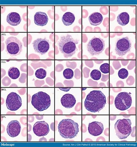 Automatic Recognition Of Atypical Lymphoid Cells