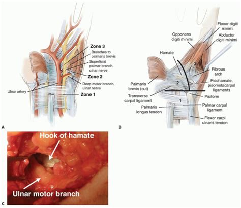 Decompression Of The Ulnar Nerve At Guyon Canal Musculoskeletal Key