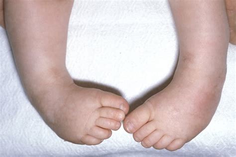 clubfoot pictures