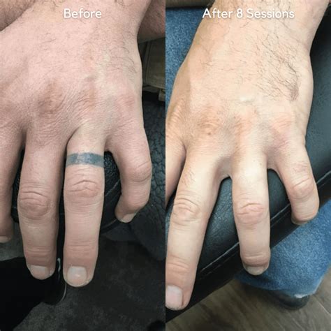 Vol 2 Best Of 2021 Before And After Tattoo Removal Results Removery