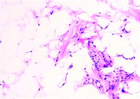 Pathological Result He Staining Of Tumor Like Hyperplasia In