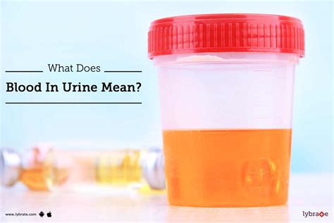 What Does Blood In Urine Mean? - By Dr. Shalabh Agrawal | Lybrate