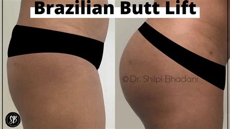Brazilian Butt Lift Before And After Dr Shilpi Bhadani Youtube