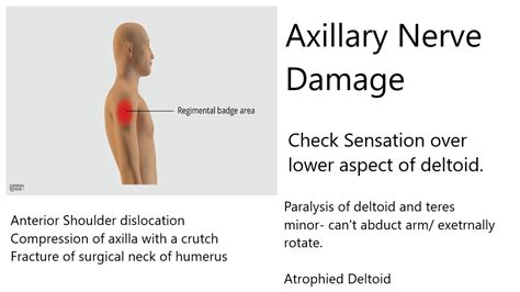 Pin By Katie Briggs On Clinical Signs Shoulder Dislocation Axillary