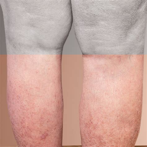 What Is Chronic Venous Insufficiency Vrogue Co