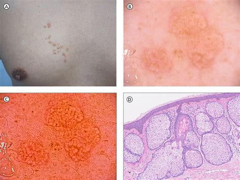 Figure 1 From Linear Sebaceous Hyperplasia On The Chest Semantic Scholar