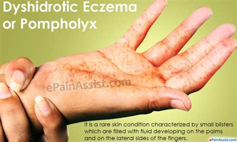 Dyshidrotic Eczema Or Pompholyx Read Skin