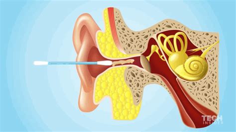 How To Remove Ear Wax 6 Home Remedies For Ear Cleaning