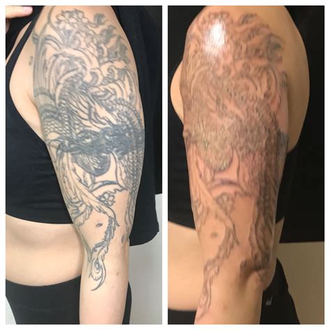 Details More Than Tattoo Removal Journey Latest Vova Edu Vn