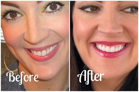 Here are 10 major benefits a minimalist attitude could bring to your life. Invisalign Treatment Wrap Up Video + Before And Afters ...